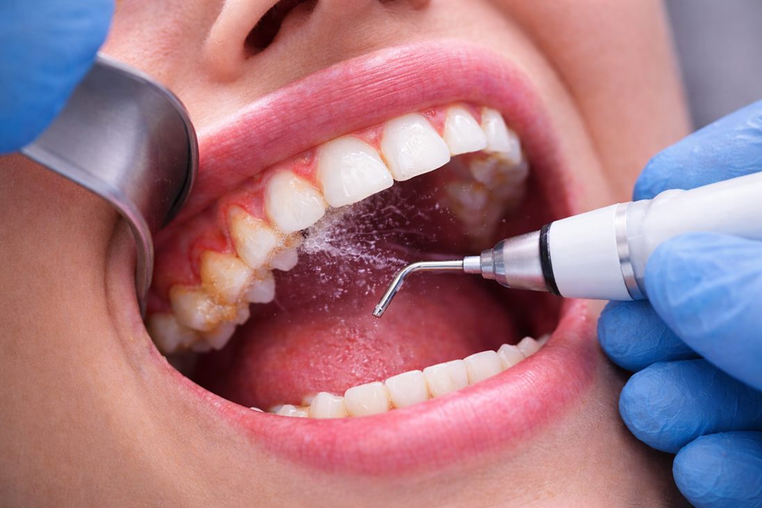 Gum Treatment